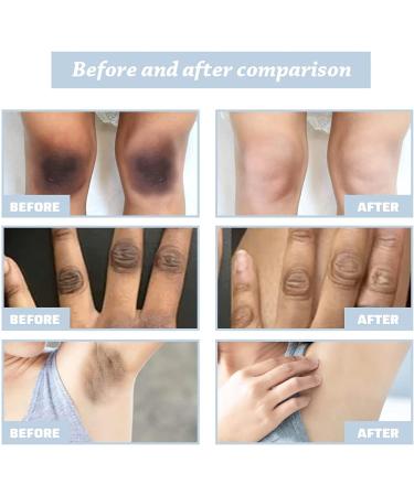 Fivfivgo Collagen Stimulating Acanthosis Nigricans Knee and Elbow Recovery Cream Dark Intensive Whitening Cream Body Cream Repair Black Spots - Buy Online on GoSupps.com