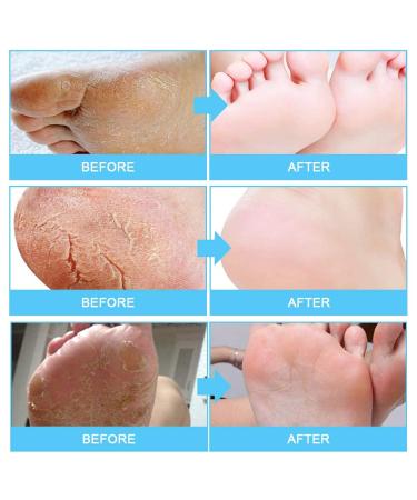 Foot Peeling Mask - 5 Pairs | Natural Exfoliator for Baby Soft Feet | Pain-Free Corn Remover for Women & Men (Milk) - Buy Online on GoSupps.com
