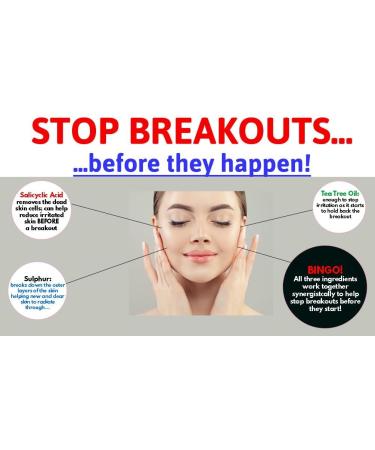 V88 MAX Breakout Cream DOUBLE STRENGTH with Salicylic Acid for Spots Blackheads Blemishes and Problem Skin Suitable and Safe for those Prone to Acne - Paraben and Cruelty FREE - 50 grams - Buy Online on GoSupps.com