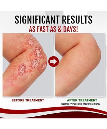 LELEBEAR Dermax Psoriasis Treatment Spray - Soothes Skin, Stops Burning and Itching (5 Pack) - Buy Online on GoSupps.com
