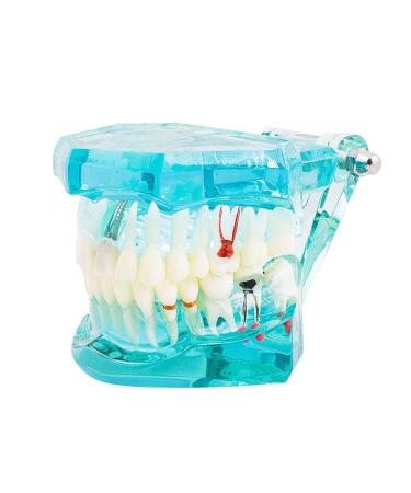 Lmeil Dental Teeth Model Transparent Dental Implantation Disease Model Dentist Pathological Standard Dental Model for Dentists who clarify research and patients