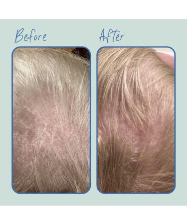 Tubby Todd Baby Cradle Cap Solution | Bye-Bye Cradle Cap Kit - Gel Shampoo Lotion & Brush - Fragrance-Free for Sensitive Skin - Buy Online on GoSupps.com