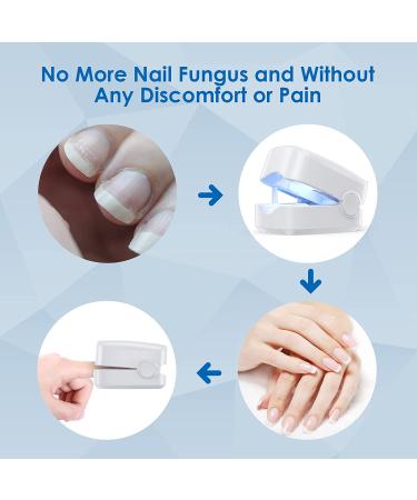Nail Fungus Cleaning Laser Device for Nails and Fingernails - Disinfects in 7 Minutes a Day - White - Buy Online on GoSupps.com
