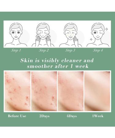 Acne Spot Treatment Cream Aliobio for Acne Scar Pimple Cream for Face & Back Acne Anti-Blemish Care 60g yellow - Buy Online on GoSupps.com