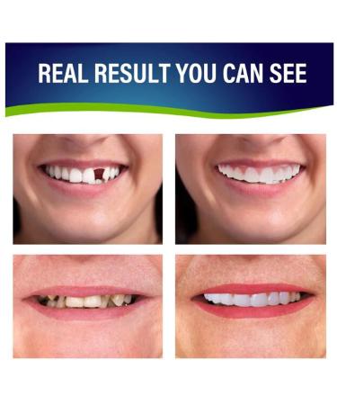 IQYU Dentures Teeth Veneer - Cosmetic Natural Shade Fix for Confident Smile | 2Pcs Clay Dentist - One Size White - Buy Online on GoSupps.com