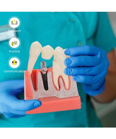 Dental Implant Model - 4 Times Removable Crown Bridge | Educational Teeth Model for Learning & Analysis - Buy Online on GoSupps.com