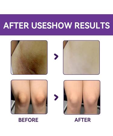 Intimate Spot Corrector Cream for Armpits Knees Elbows Inner Thighs Intimate Parts Cream for Intimate Skin (1 Piece) - Buy Online on GoSupps.com