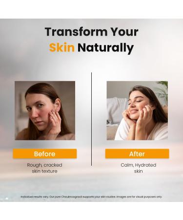 Deve Herbes Pure Chaulmoogra Oil (Hydnocarpus wightiana) Cold Pressed 630ml (21 oz) - Buy Online on GoSupps.com