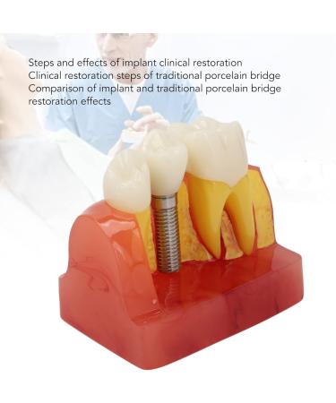 Verdant Touch Crown Bridge Demonstration Model - 4X Dental Implant Model for Doctor-Patient Education | International Shipping - Buy Online on GoSupps.com