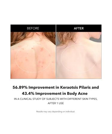 APRILSKIN Carrotene IPMP Exfoliating Body Wash | Salicylic Acid Body Wash Improve Rough & Bumpy Skin Body Acne Keratosis Pilaris with Niacinamide & Ceramides | Vegan & Cruelty-free | 10.14 fl.oz - Buy Online on GoSupps.com