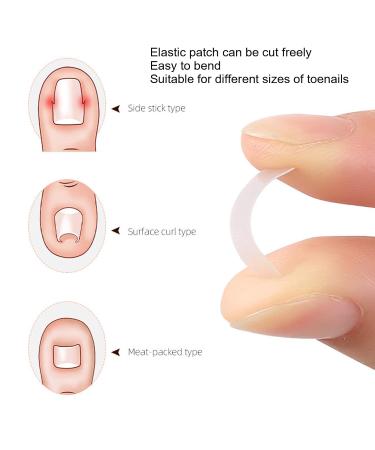 10 Pieces Painless Correction Strips for Ingrown Toenails | Paronychia Treatment Patches - International Shipping - Buy Online on GoSupps.com
