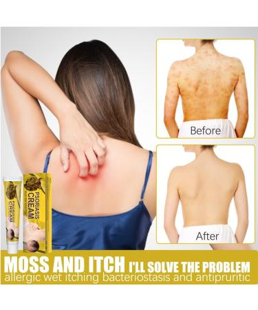 VEJIA Eczema Psoriasis Treatment Cream 20g - Dermatitis Pruritus Relief Ointment for Adults (3pcs) - Buy Online on GoSupps.com