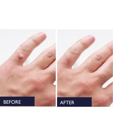 Fast Action Liquid Wart Gel - Maximum Strength Salicylic Acid Treatment for Warts Corns & Calluses | Fast-Acting Wart Remover - Buy Online on GoSupps.com