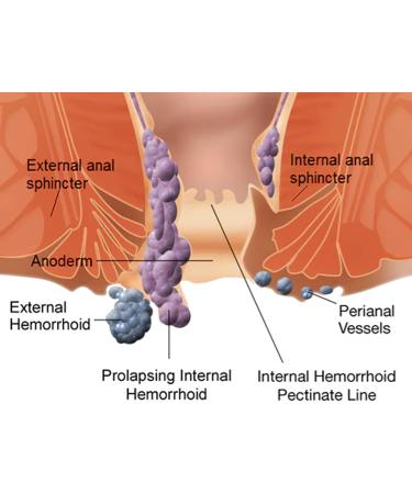 Heca Natural Herbal Hemorrhoid Relief Capsules - Fast Acting Treatment for Itching, Burning, Pain & Discomfort - 7Pcs/Box, 3 Boxes - Buy Online on GoSupps.com