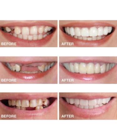 2 Pairs Adjustable Temporary Teeth - Nature-Friendly & Comfortable for a Confident Smile - International Shipping - Buy Online on GoSupps.com