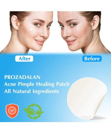 Acne Patch - 216 Invisible Hydrocolloid Patches for Effective Acne Relief | Suitable for All Skin Types - Buy Online on GoSupps.com