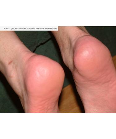 Natural Products Black Callus Ex - Effective Callus Remover & Foot Cream 100ml | Fast International Shipping - Buy Online on GoSupps.com