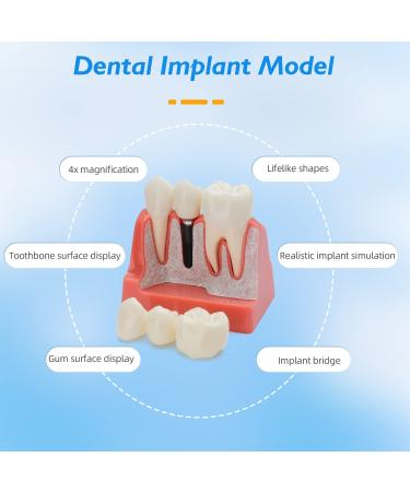 Dental Implant Model - 4 Times Removable Crown Bridge | Educational Teeth Model for Learning & Analysis - Buy Online on GoSupps.com