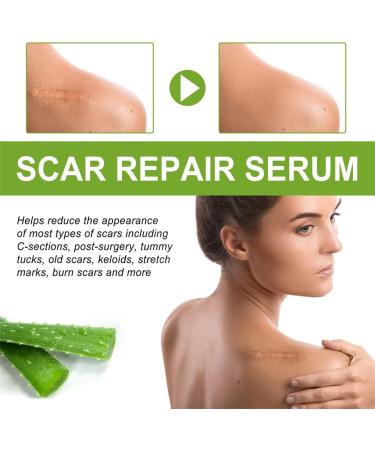 lmoikesz Leg Hip Chest Stretch Marks Serum Body Burns Scars Removal Serum Girls Skin Care Repair Essence 30ml - Buy Online on GoSupps.com