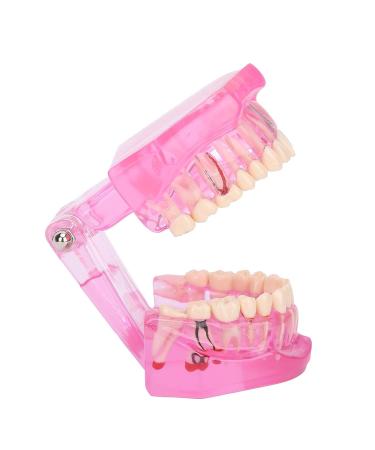 Transparent Adult Teeth Model - Pathological Removable Dental Teaching Tool Standard Size - Ideal for Study & Repairs - Buy Online on GoSupps.com