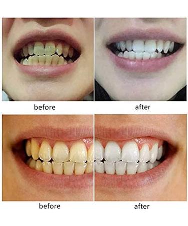 Instant Dentures & Provisional Cosmetic Teeth for Men & Women | Comfortable Silicone Veneers - Reusable Repair Prosthesis - Buy Online on GoSupps.com