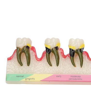 Dental Periodontal Disease Model Tooth Disease Study Teaching Model for Dental School - Buy Online on GoSupps.com