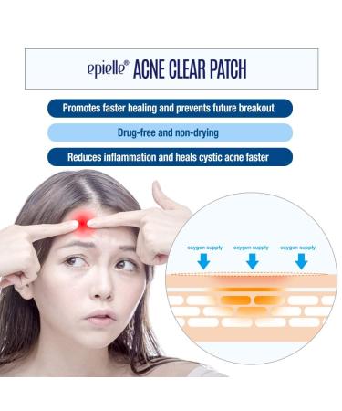Epielle Acne Clear Patch - Hydrocolloid Pimple Patch for Face & Skin, 4 Pack Acne Spot Treatment Stickers - Cruelty-Free, Two Patch Sizes 8mm & 10mm - Buy Online on GoSupps.com