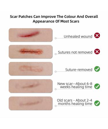 Silicone Scar Sheet & Tape for Effective Keloid Treatment | 1.6 x 120 Roll - Improve Surgery C-Section & Surgical Scar Healing - Buy Online on GoSupps.com
