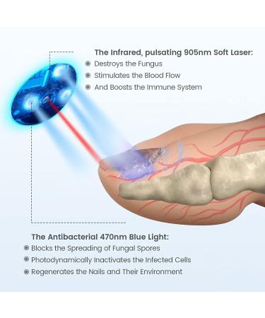 Toenail Fungus Laser Treatment Device - Effective Nail Fungal Cleaner for Onychomycosis on Fingernail & Toenail - Toe Fungus Nail Treatment - Buy Online on GoSupps.com
