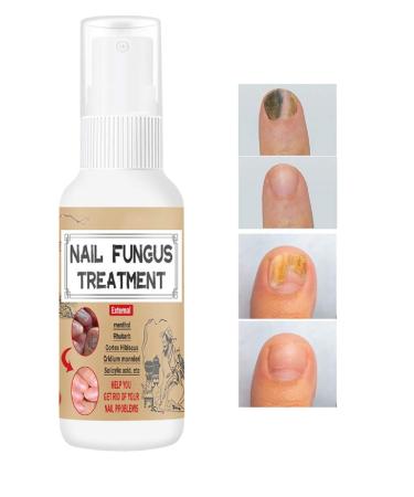 Nail Fungus Treatment for Toenail, Effective Toenail Fungus Treatment - Restores The Healthy Appearance of Nails original