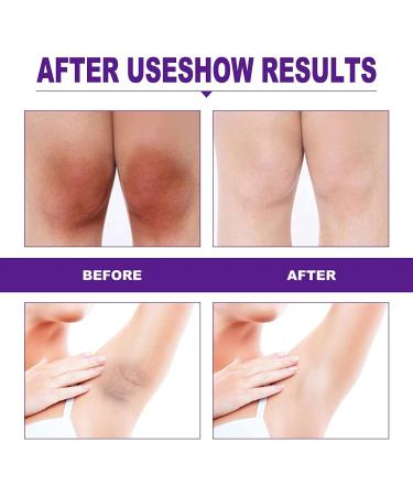 1/2/3pcs Whitening Cream for Private Parts Dark Spot Corrector Cream for Inner Thighs Thigh Line Armpits and Knees (1pcs 20ml) - Buy Online on GoSupps.com