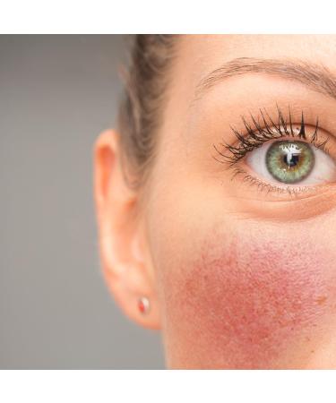 Prontomed Couperose Cream soothing care against redness and visible veins 7herb complex with horse chestnut & Centella Asiatica moisturizing and regenerating 50 ml - Buy Online on GoSupps.com