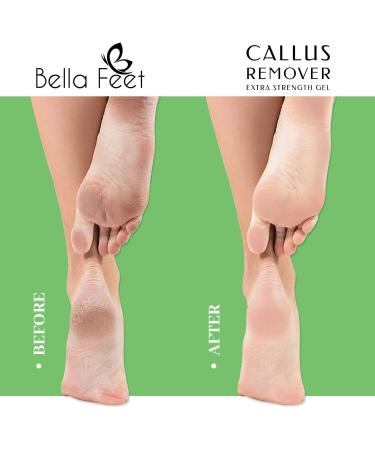 Extra-Strength Bella Feet Callus Remover Kit with Scrubber, Gloves & Repair Cream - Professional Foot Care for Dry Cracked Heels - 8.45oz/50ml - Buy Online on GoSupps.com