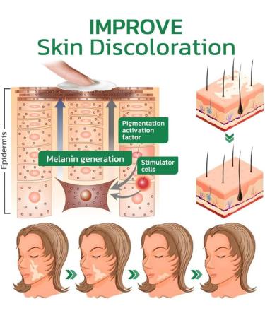 GFOUK Vitiligo Treatment Cream - Soothing White Spot & Psoriasis Relief (2pcs) - Buy Online on GoSupps.com