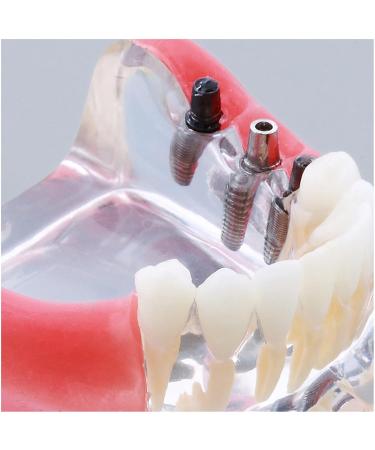 Dental Upper Implantate Model - Superior Overdenture Restoration for Education | Transparent Vision & Soft Gum - Ideal Study Tool - Buy Online on GoSupps.com