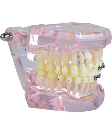 Buy Liusu Children's Tooth Theory Dental Model - Transparent Implant & Orthodontic Demo Model with Self-Ligating Clips | International Shipping Available - Buy Online on GoSupps.com