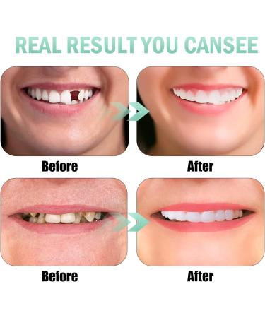 6 PCS Fake Dentures Teeth for Women and Men - Dental Veneers for Temporary Restoration - Comfortable & Natural Shade to Protect Teeth and Restore Smile - Buy Online on GoSupps.com