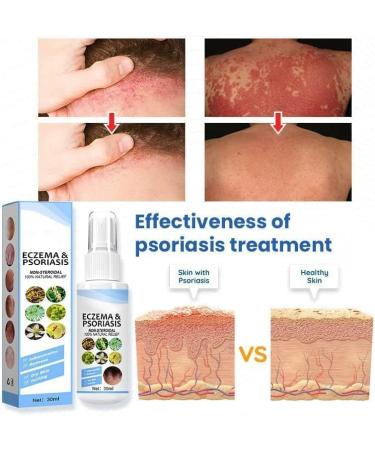 Yanolam Meellop Herbal Psoriasis Relief Spray - Soothes and Moisturizes, Stops Itching & Burning - 3 pc Eczema Relief Set - Buy Online on GoSupps.com