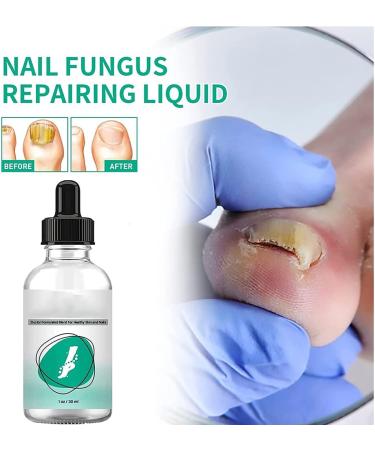 ZZBD 30ML-Kerassentials Toenail Fungus Treatment Oil Kerassentials Nail Treatment Kerassentials for Toenail Fungus for Healthy Natural Repair Nails-3pcs - Buy Online on GoSupps.com