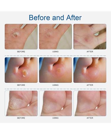 MQUPIN Corn Remover Pads Wart Remover Pads Foot Corn Remover Pads Plantar Wart Removal Corn Callus Remover Penetrates and Removes Common and Plantar Warts with Hole Callus Stops Wart Regrowth (24 PCS) - Buy Online on GoSupps.com