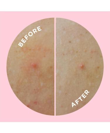 ZitSticka Hydrocolloid Body Patches - 9 Pack GOO GETTER | Effective Acne Treatment for Body Zits | Exfoliating & Moisturizing Blemish Patches - Buy Online on GoSupps.com