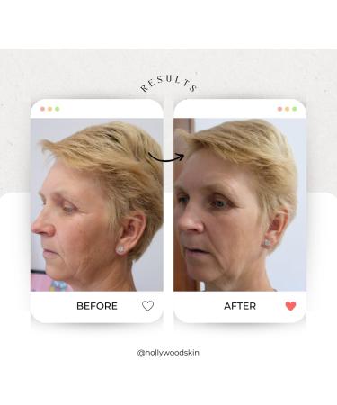 Best Anti-Aging Face Lift Serum - Award-Winning 2.5% Retinol with 11% Hyaluronic Acid, Vitamin C & E, Aloe Vera - 30ml - Buy Online on GoSupps.com