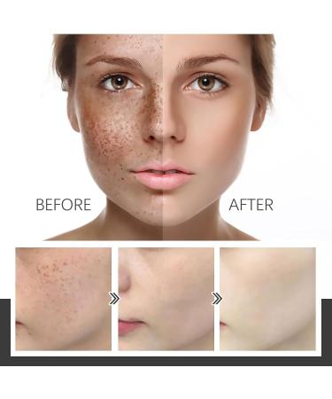 KOAHDE Fade Pigment Facial Serum Whitening Freckle Serum Remove Dark Spot Facial Serum Fade Melanin Facial Serum Melanin Correcting Skin Care Serum Brighten Facial Serum Pigment Care Serums 30ML - Buy Online on GoSupps.com