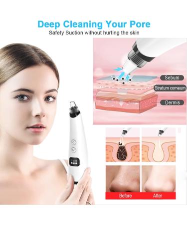 Sungive Blackhead Remover Vacuum - Electric Facial Pore Cleaner for Men & Women - 5 Suction Heads for Whiteheads, Blackheads, Acne & Blemish Removal - Buy Online on GoSupps.com