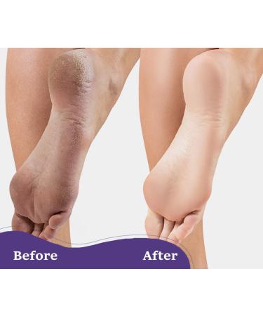 6 Packs Foot Pumice Stone Double Sided Foot Scrub for Feet Hard Skin Callus Remover and Scrubber Exfoliating Dead Skin - Buy Online on GoSupps.com