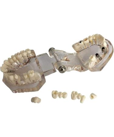 Buy DYTAH Transparent Teeth Model - Removable Pathological Tooth for Dental Training & Examination | International Shipping - Buy Online on GoSupps.com