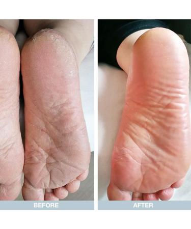 Australian Bodycare 100ml Foot Cream | Hard Skin Remover for Women & Men | 10% Urea Treatment for Dry & Cracked Feet | Tea Tree Oil Foot Care for Sweaty Feet - Buy Online on GoSupps.com