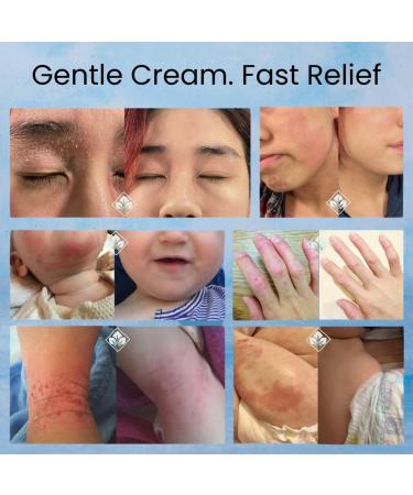 Organic Baby Eczema Cream - Soothing Relief for Dry Itchy Skin Psoriasis Dermatitis & Hives | Non-Greasy Balm for Lasting Hydration - Buy Online on GoSupps.com