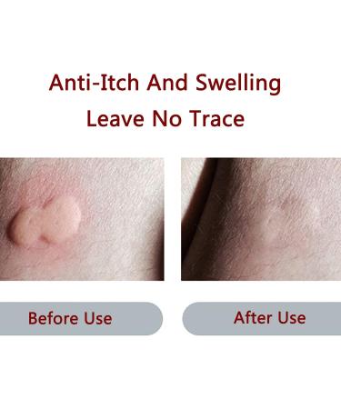 Mosquito Antipruritic Device Electric Mosquito Bite Treatment Tool with Adjusted 3 Levels of Temperature 30S Quick Chemical-Free Treatment Does Not Hurt The Skin for Relieve Itching - Buy Online on GoSupps.com