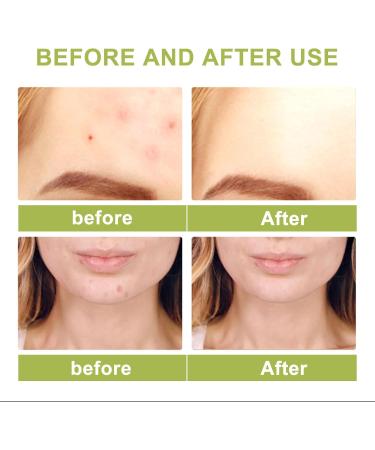 Tea Tree Ance Serum Tea Tree Essential Oils Tea Tree Oil For Skin Anti-Pimples and Acne Moisturizer and Brighten Skin.Tea Tree Oil for Diffuser Humidifier DIY Home Office 100ml - Buy Online on GoSupps.com